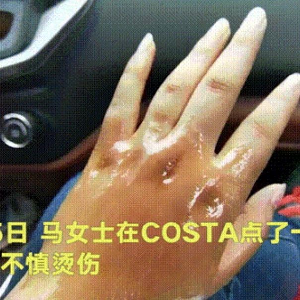 COSTA顧客被燙傷懷疑茶具設計缺陷？大家平常喝熱飲的時候，要非常注意！